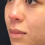 Non Surgical Rhinoplasty Before & After Patient #1314