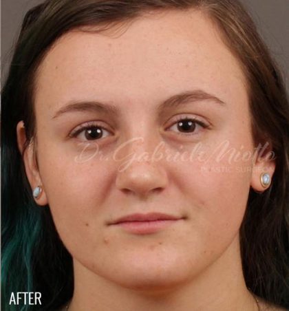 Rhinoplasty Before & After Patient #1192