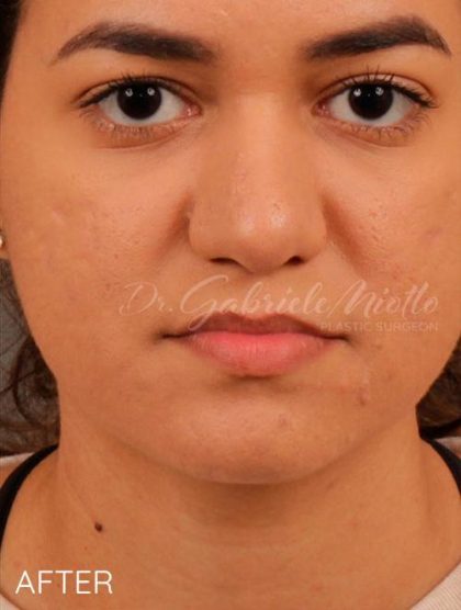 Rhinoplasty Before & After Patient #1189