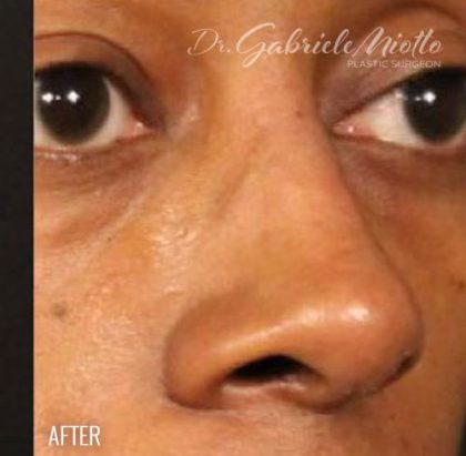 Before & After Patient #1185