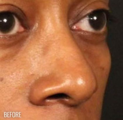 Before & After Patient #1185