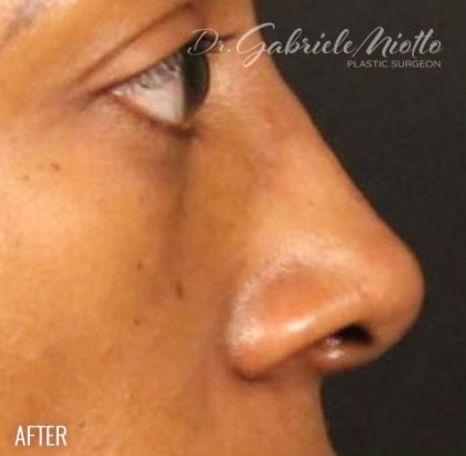Before & After Patient #1185