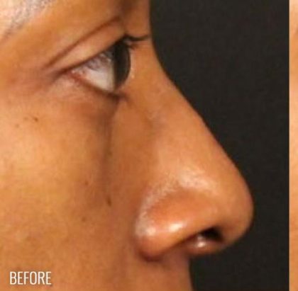 Before & After Patient #1185