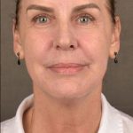 Skin Resurfacing Before & After Patient #1318