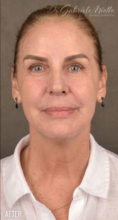 Skin Resurfacing Before & After Patient #1318