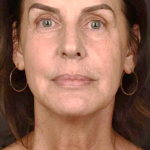 Skin Resurfacing Before & After Patient #1318