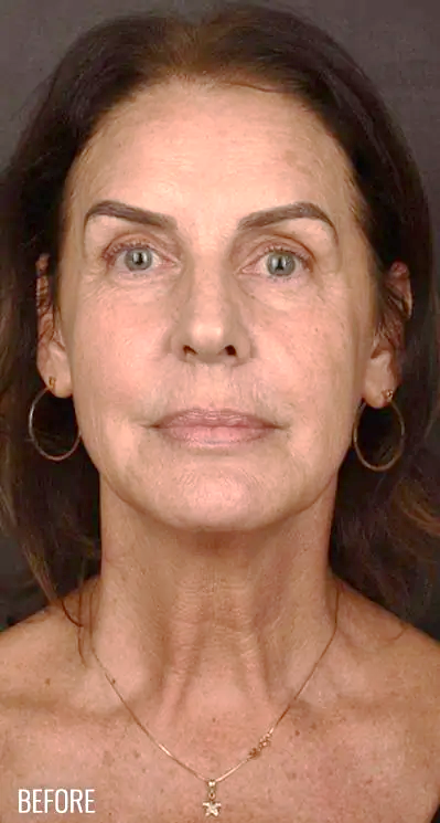 Skin Resurfacing Before & After Patient #1318