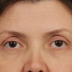 Facial Fat Grafting Before & After Patient #2578