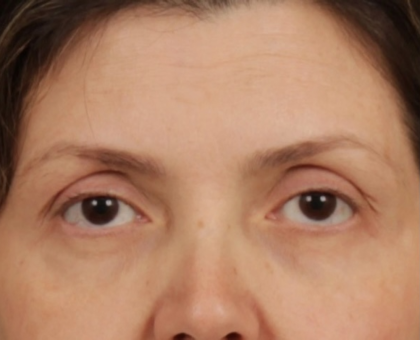 Facial Fat Grafting Before & After Patient #2578