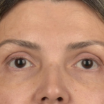 Facial Fat Grafting Before & After Patient #2578