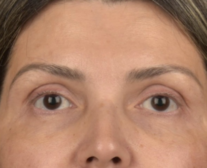 Facial Fat Grafting Before & After Patient #2578