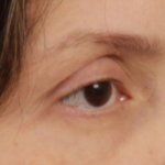 Facial Fat Grafting Before & After Patient #2578