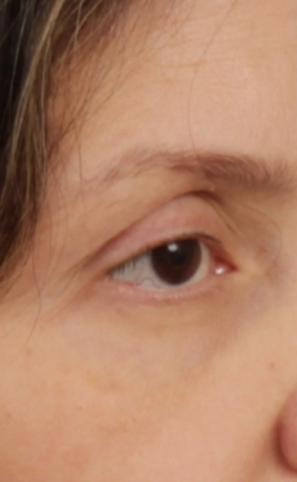Facial Fat Grafting Before & After Patient #2578