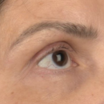 Facial Fat Grafting Before & After Patient #2578