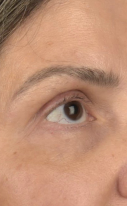 Facial Fat Grafting Before & After Patient #2578