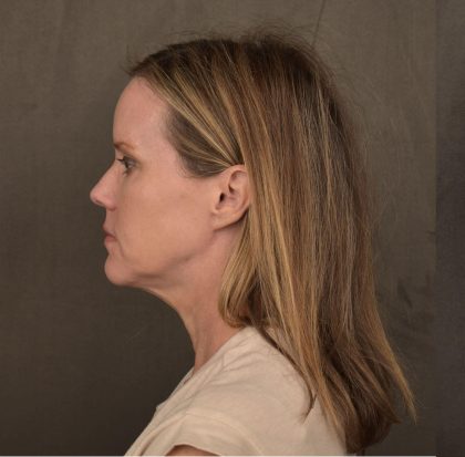 Facelift Before & After Patient #2597