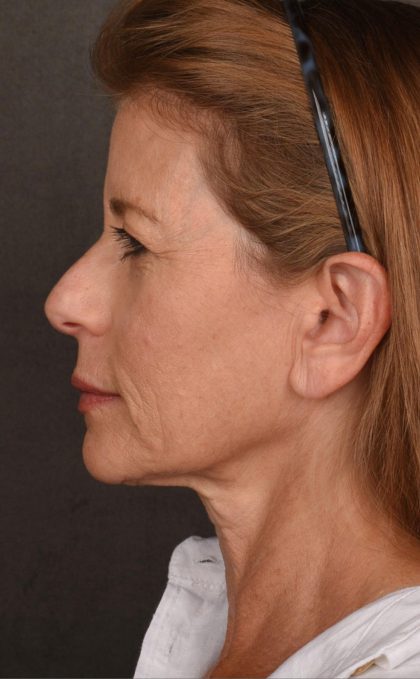 Facelift Before & After Patient #2868