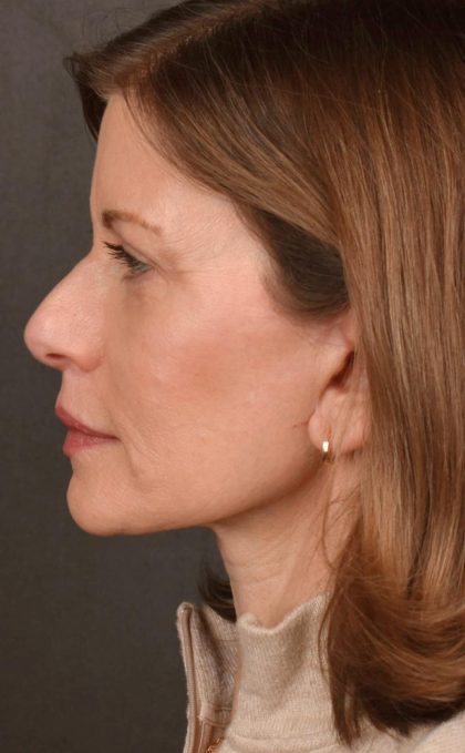 Facelift Before & After Patient #2868