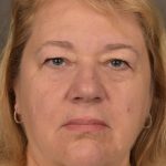 Facelift Before & After Patient #2869