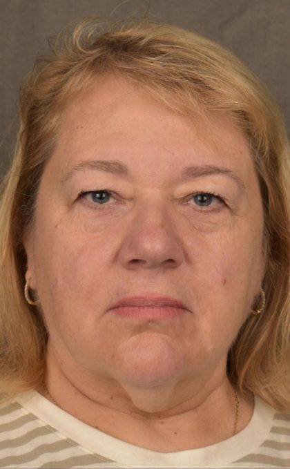 Facelift Before & After Patient #2869