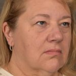 Facelift Before & After Patient #2869