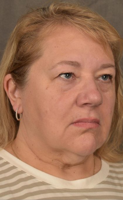 Facelift Before & After Patient #2869