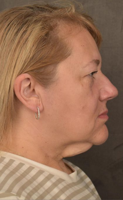 Facelift Before & After Patient #2869