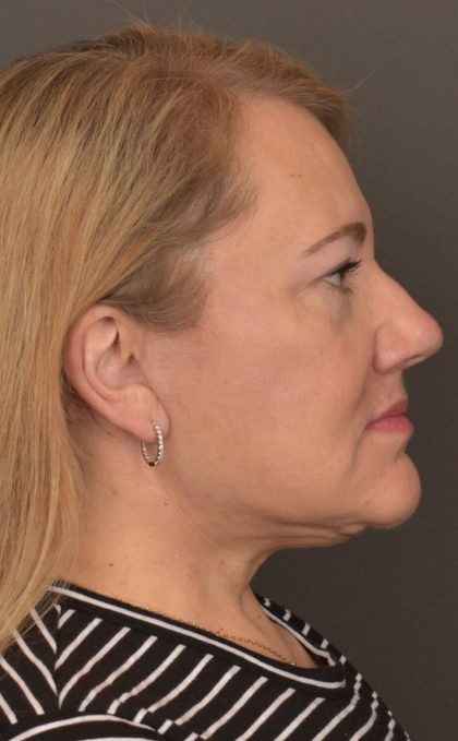 Facelift Before & After Patient #2869