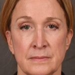 Facelift Before & After Patient #2870