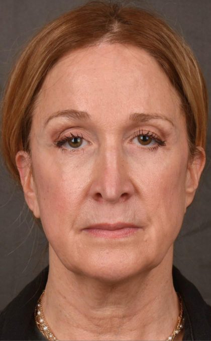 Facelift Before & After Patient #2870