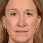 Facelift Before & After Patient #2870