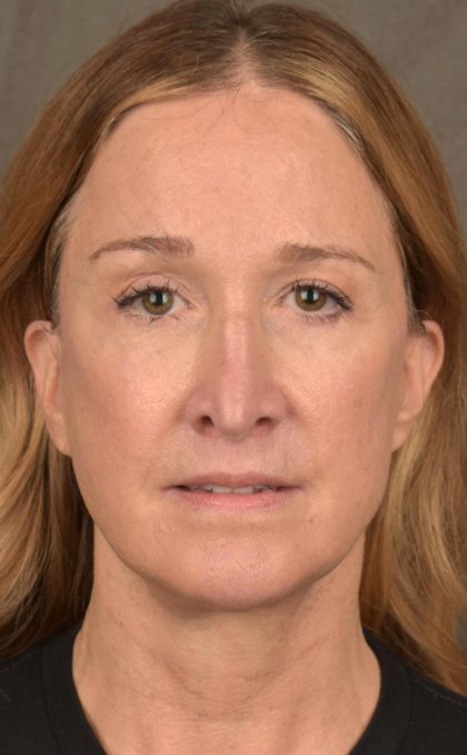 Facelift Before & After Patient #2870