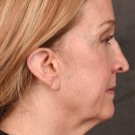 Facelift Before & After Patient #2870