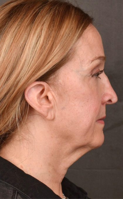 Facelift Before & After Patient #2870