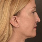 Facelift Before & After Patient #2870