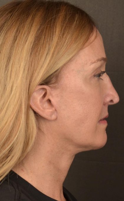 Facelift Before & After Patient #2870