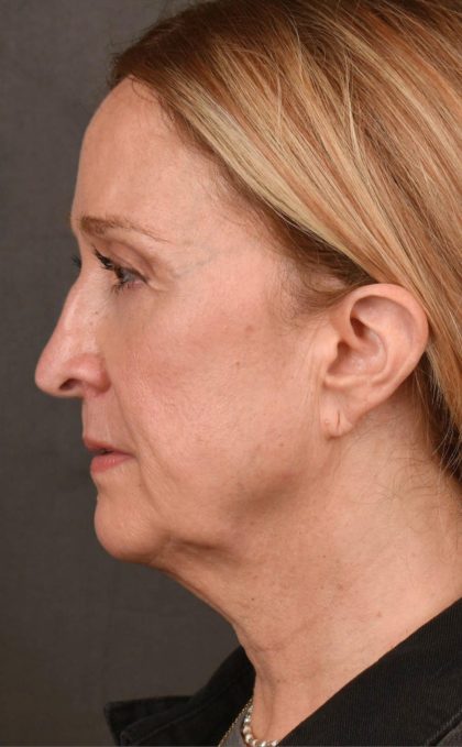 Facelift Before & After Patient #2870