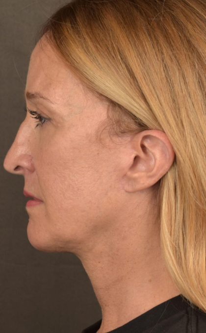 Facelift Before & After Patient #2870