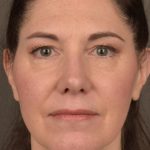 Facelift Before & After Patient #2871