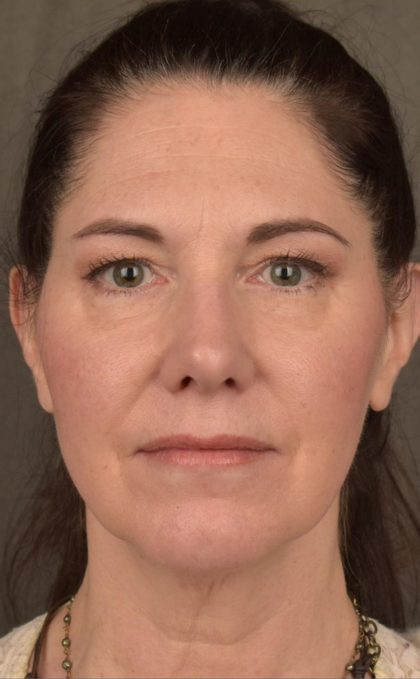 Facelift Before & After Patient #2871