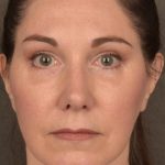 Facelift Before & After Patient #2871