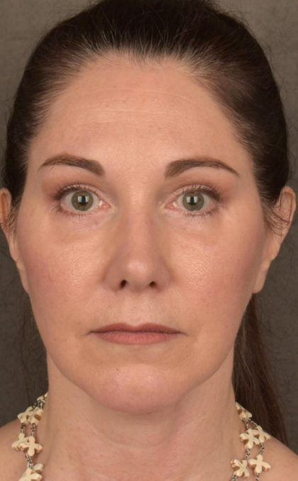 Facelift Before & After Patient #2871