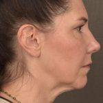 Facelift Before & After Patient #2871
