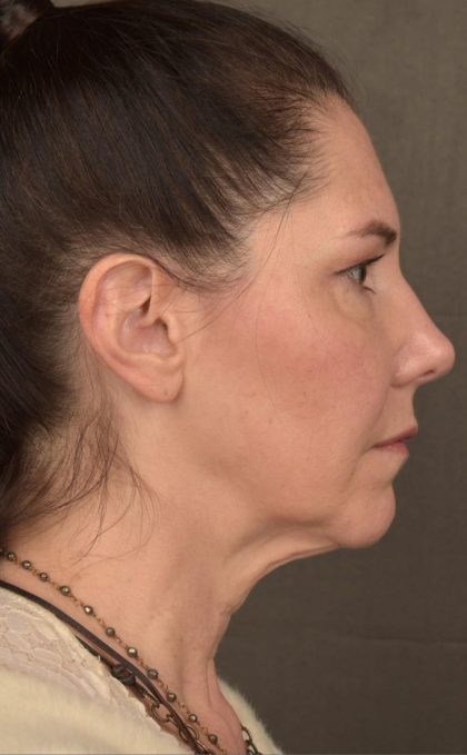 Facelift Before & After Patient #2871