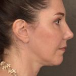Facelift Before & After Patient #2871
