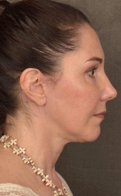 Facelift Before & After Patient #2871