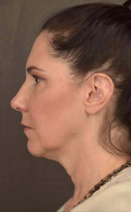 Facelift Before & After Patient #2871