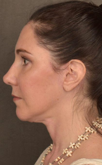 Facelift Before & After Patient #2871