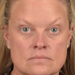 Facelift Before & After Patient #2872