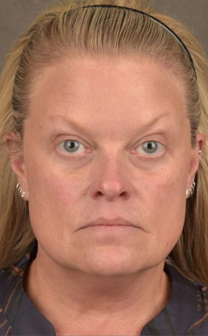 Facelift Before & After Patient #2872